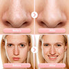 Blackhead Remover Pore Vacuum