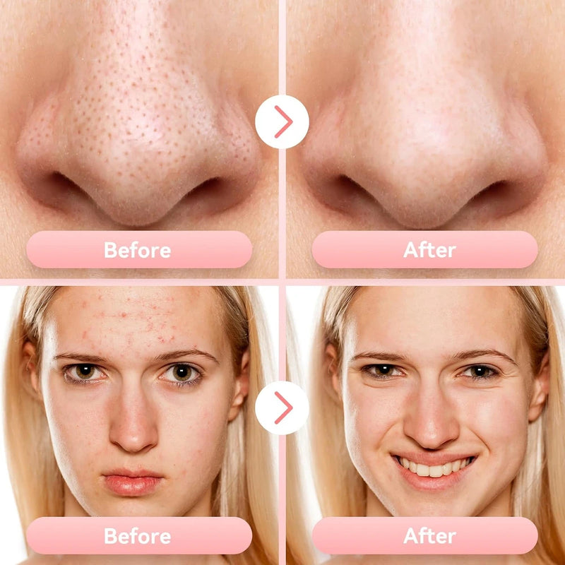 Blackhead Remover Pore Vacuum